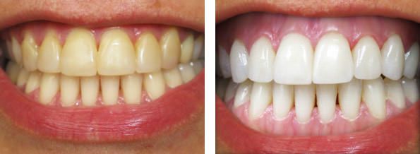 bio white denti funziona