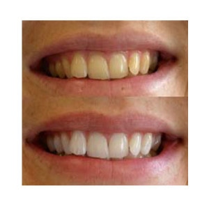 sbiancante denti bio white natural fit prima e dopo